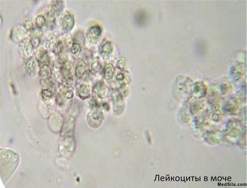 Лейкоциты в моче